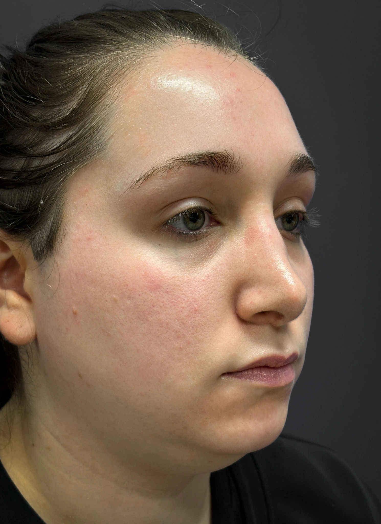 Submental-Liposuction-Case--3439 | Before Submental Liposuction 4