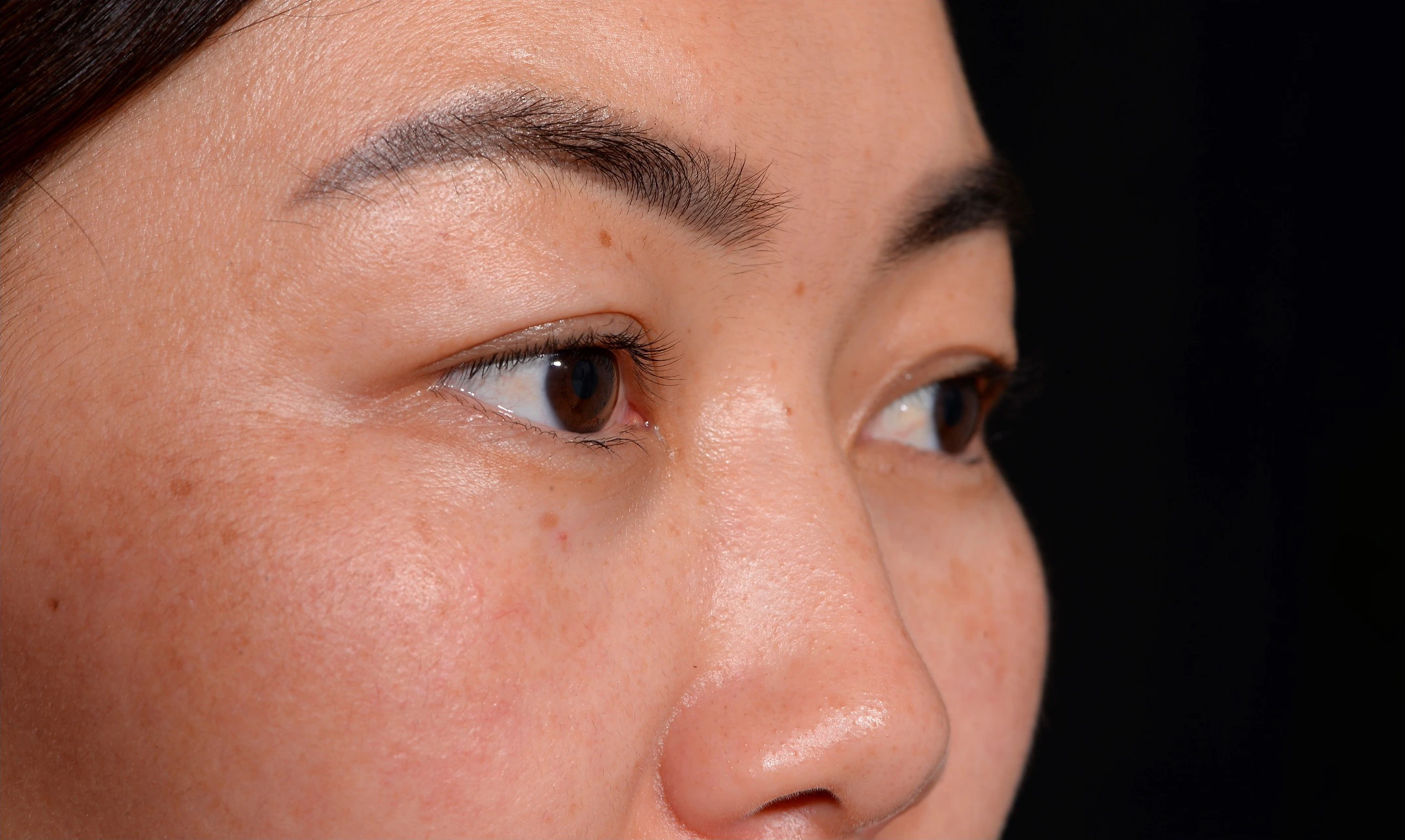 Blepharoplasty-Case--356 | Before Eyelid Surgery 3