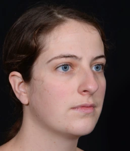 Rhinoplasty-and-Chin-Implant-Case--381 | Before Rhinoplasty 2