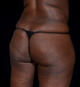 Brazilian-Butt-Lift-Case--353 | Before Brazilian Butt Lift 2