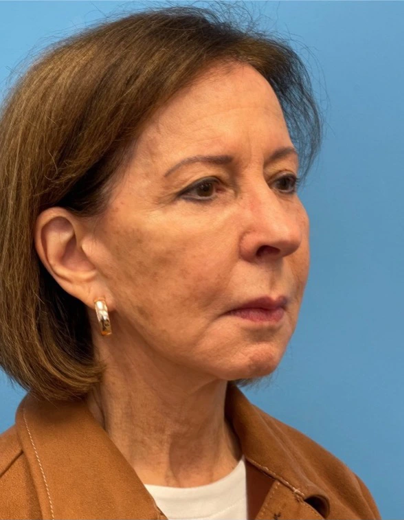 Facelift-Case--25941 | Before Facelift 2