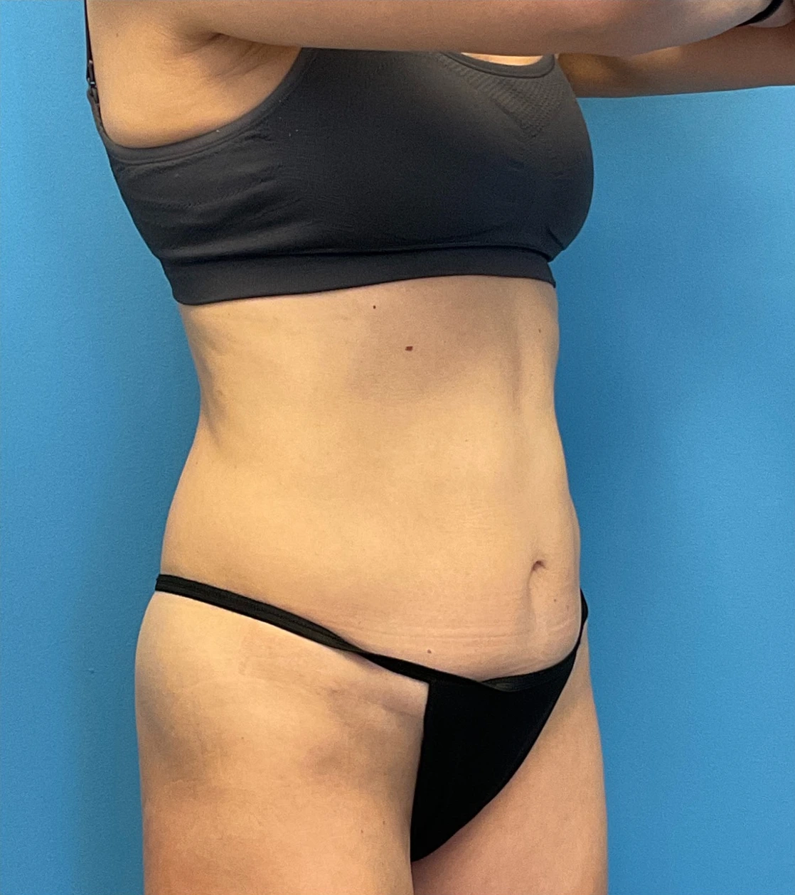 Revision-Tummy-Tuck-Case--23643 | Before Tummy Tuck 4