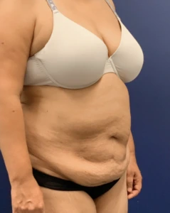 Liposuction-Abdominoplasty-Case--25576 | Before Liposuction 2