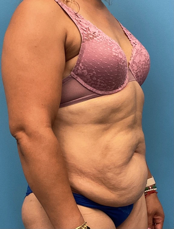 Tummy-Tuck-Case--25988 | Before Tummy Tuck 4