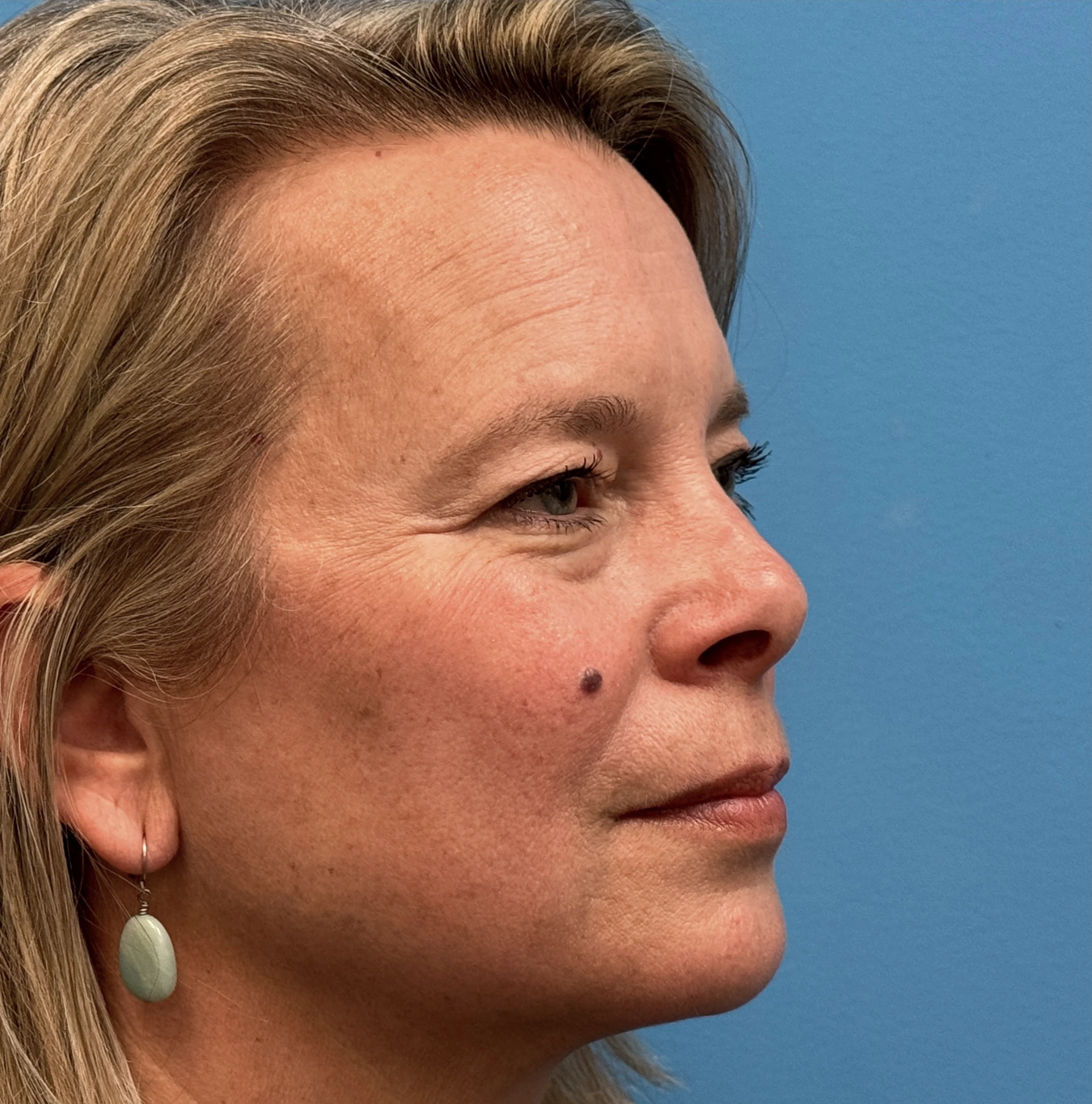 Blepharoplasty-Case--13622 | Before Eyelid Surgery 4