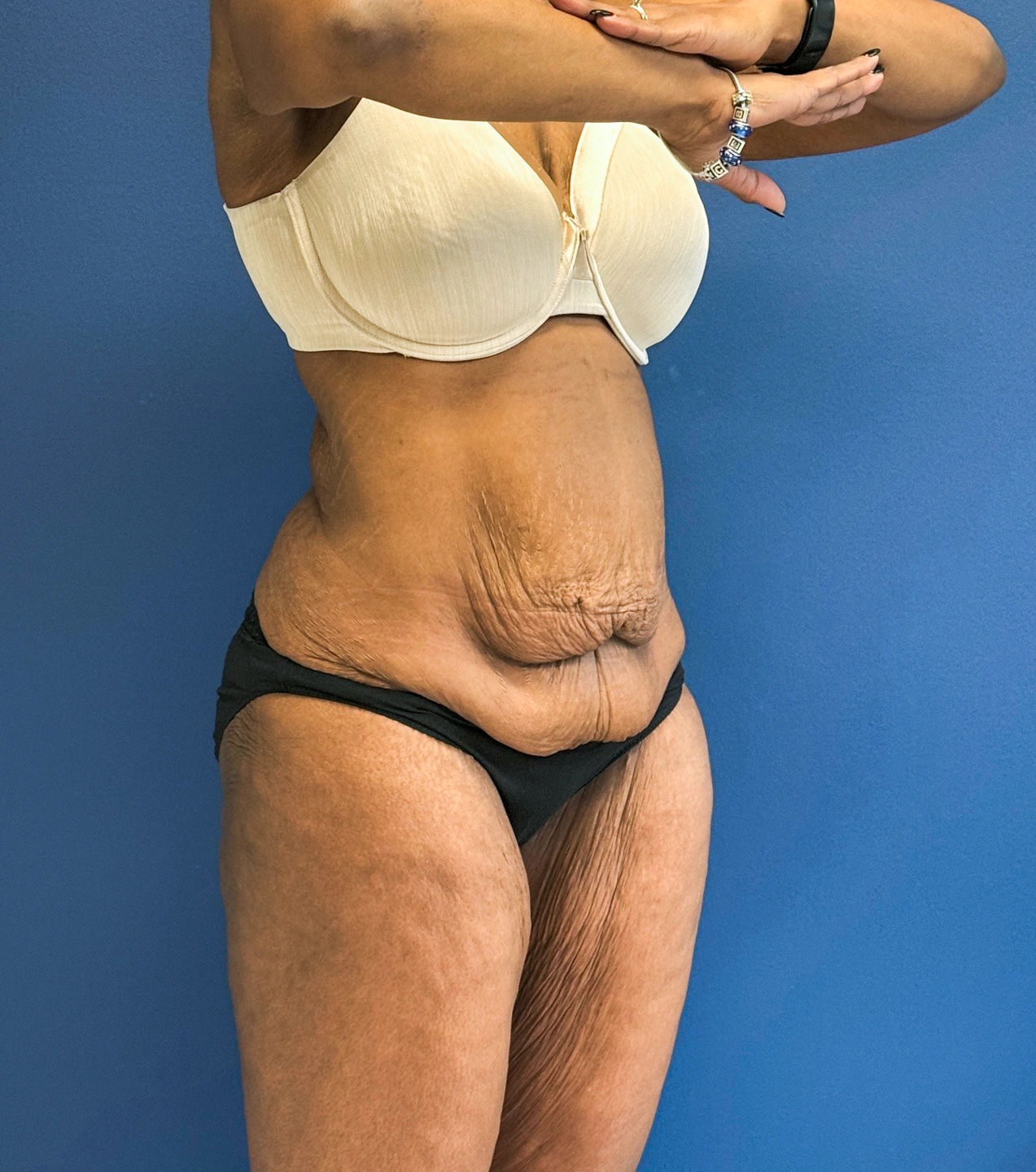 Tummy-Tuck-Case--28714 | Before Tummy Tuck 5