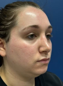 Submental-Liposuction-Case--29107 | Before Submental Liposuction 2