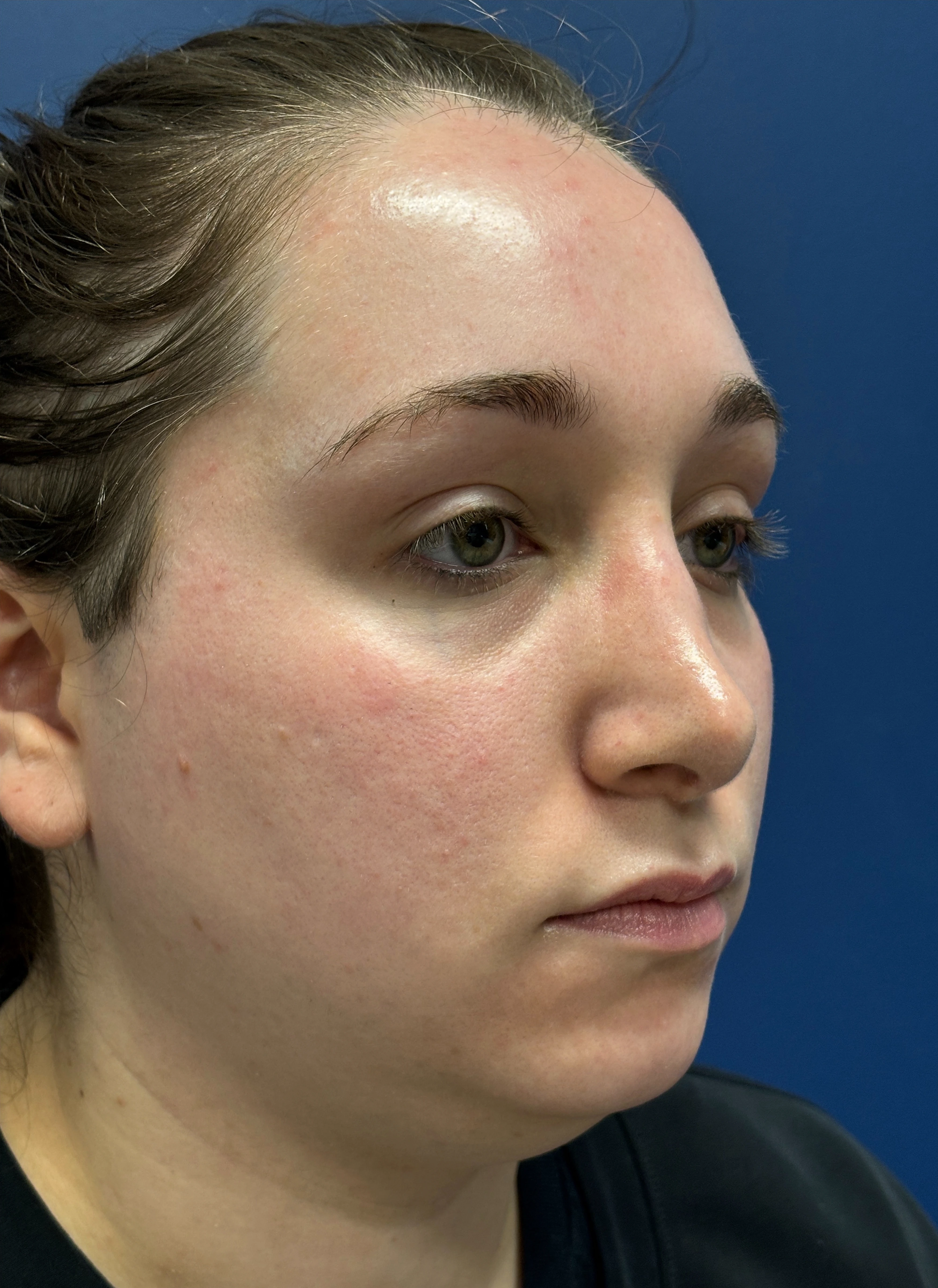 Submental-Liposuction-Case--29107 | Before Submental Liposuction 2