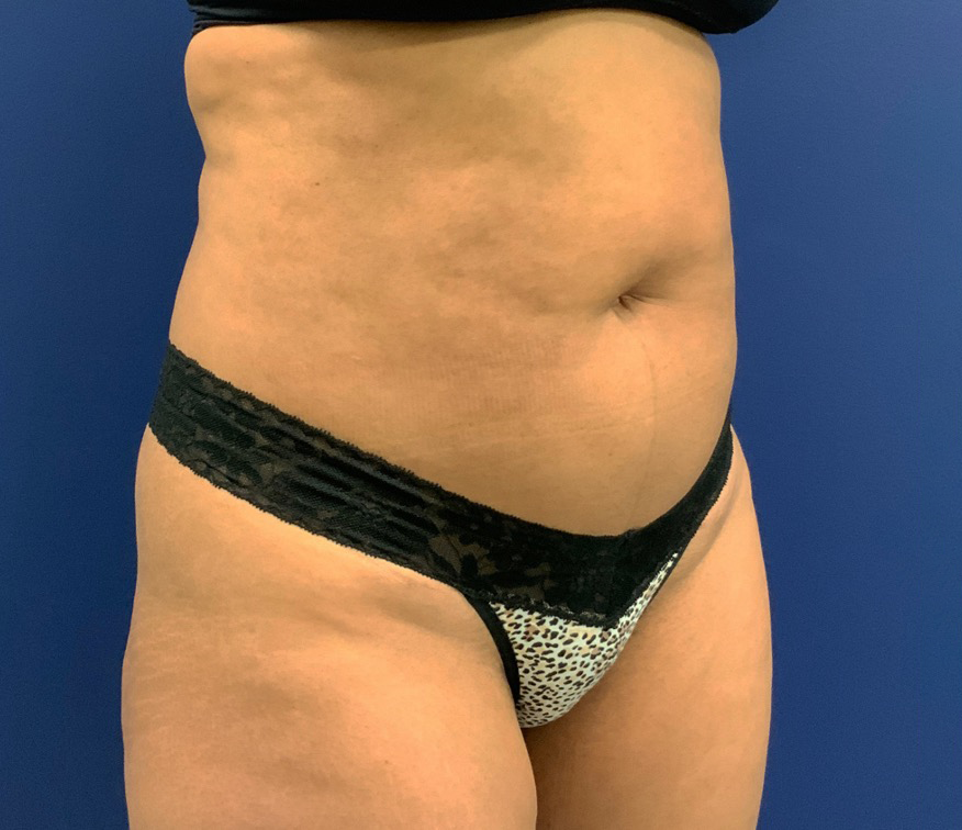 Lipoabdominoplasty-Case--21755 | Before Tummy Tuck 3
