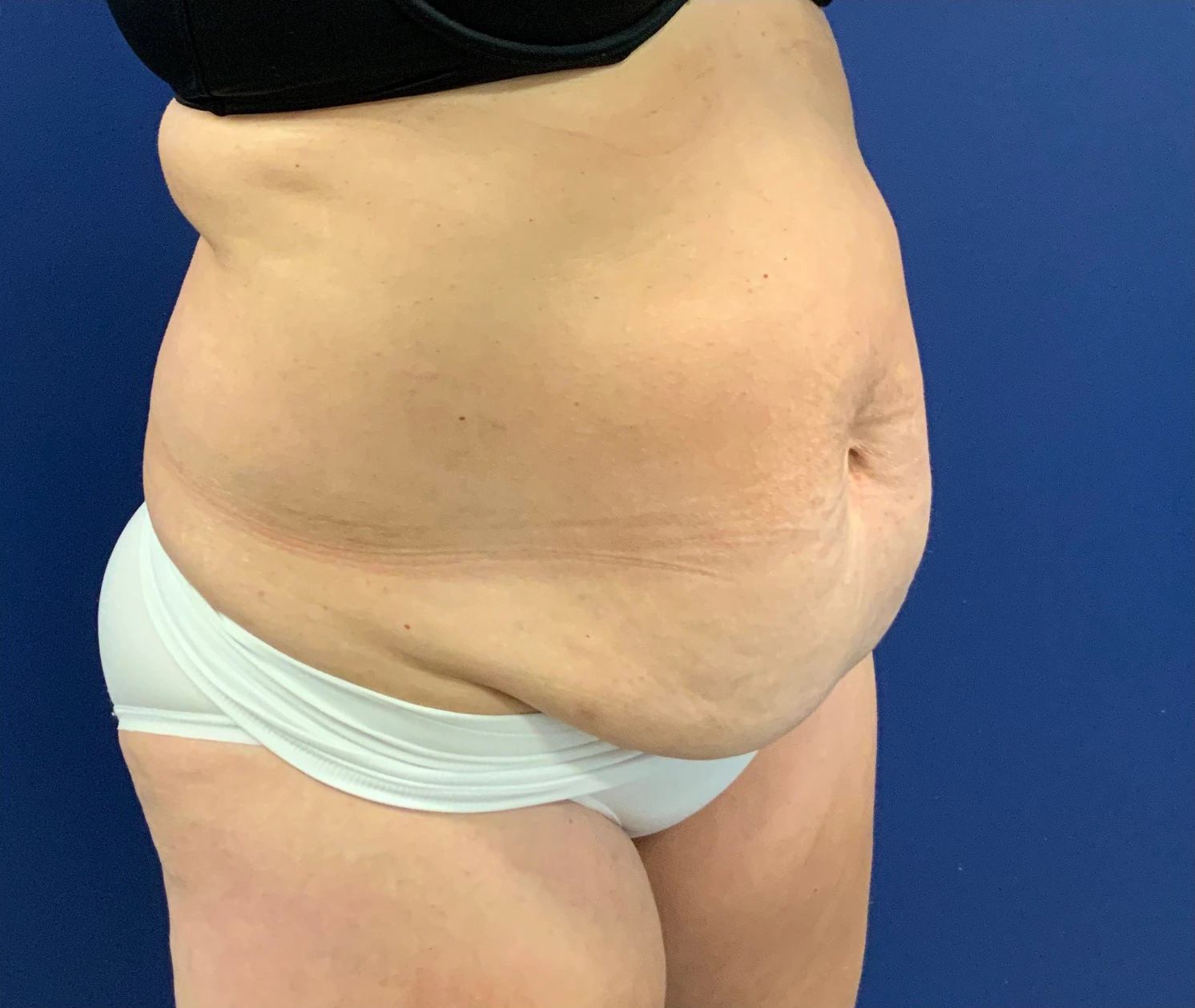 Abdominoplasty-Case--21804 | Before Tummy Tuck 3