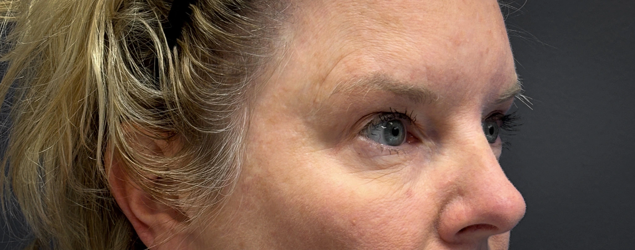 Blepharoplasty-Case--7015 | Before Eyelid Surgery 3