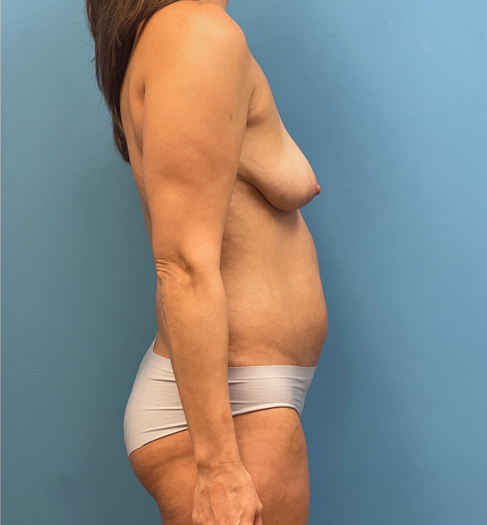 Breast-Augmentation-Tummy-Tuck-Case--28080 | Before Body Lift 4