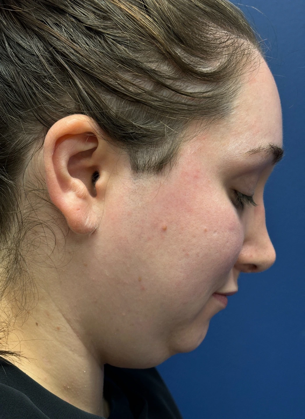 Submental-Liposuction-Case--29107 | Before Submental Liposuction 6