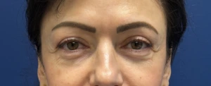 Lower-Blepharoplasty-Case--26939 | Before Eyelid Surgery 2