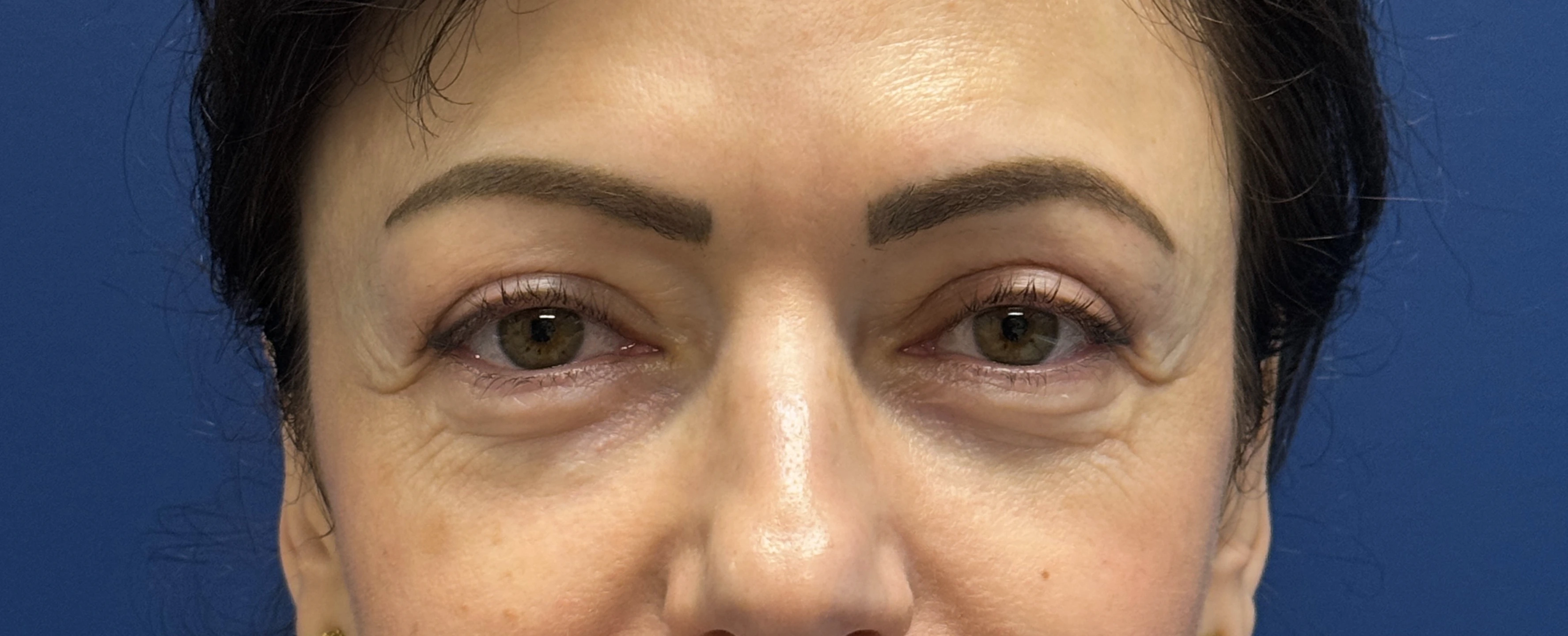 Lower-Blepharoplasty-Case--26939 | Before Eyelid Surgery 2