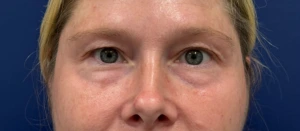 Blepharoplasty-Case--29601 | Before Eyelid Surgery 2