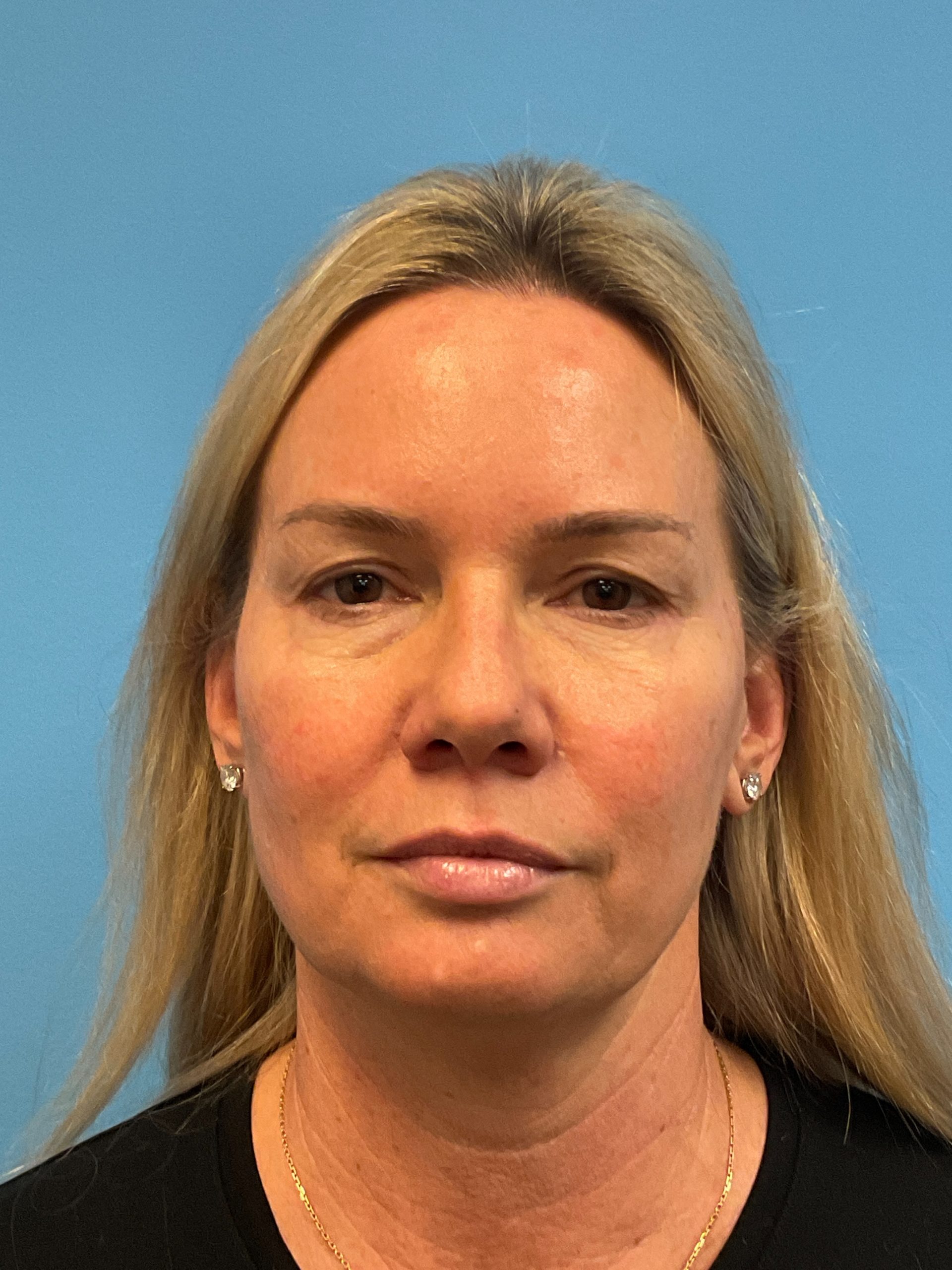 Facelift-Facial-Fat-Grafting-Necklift-Blepharoplasty-Case--9823 | Before Eyelid Surgery 1