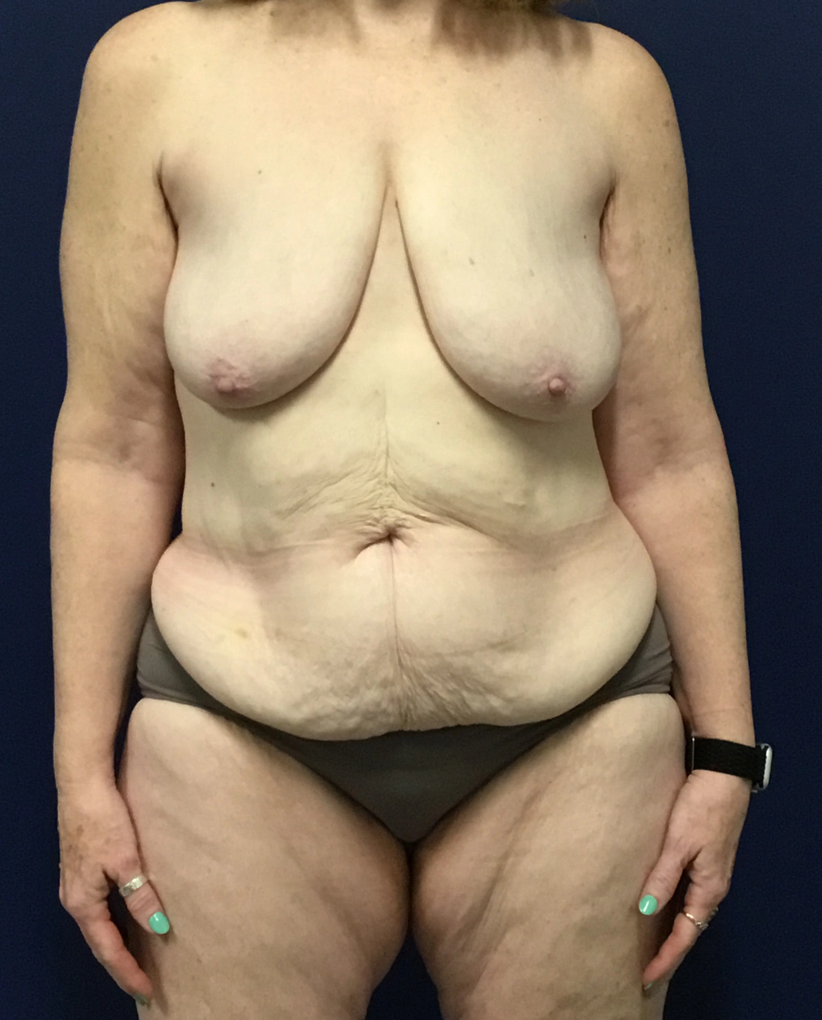 Abdominoplasty-Case--7412 | Before Tummy Tuck 1