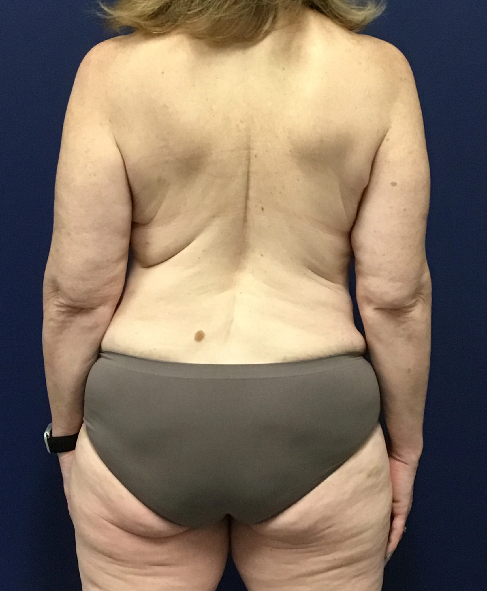 Abdominoplasty-Case--7412 | Before Tummy Tuck 6