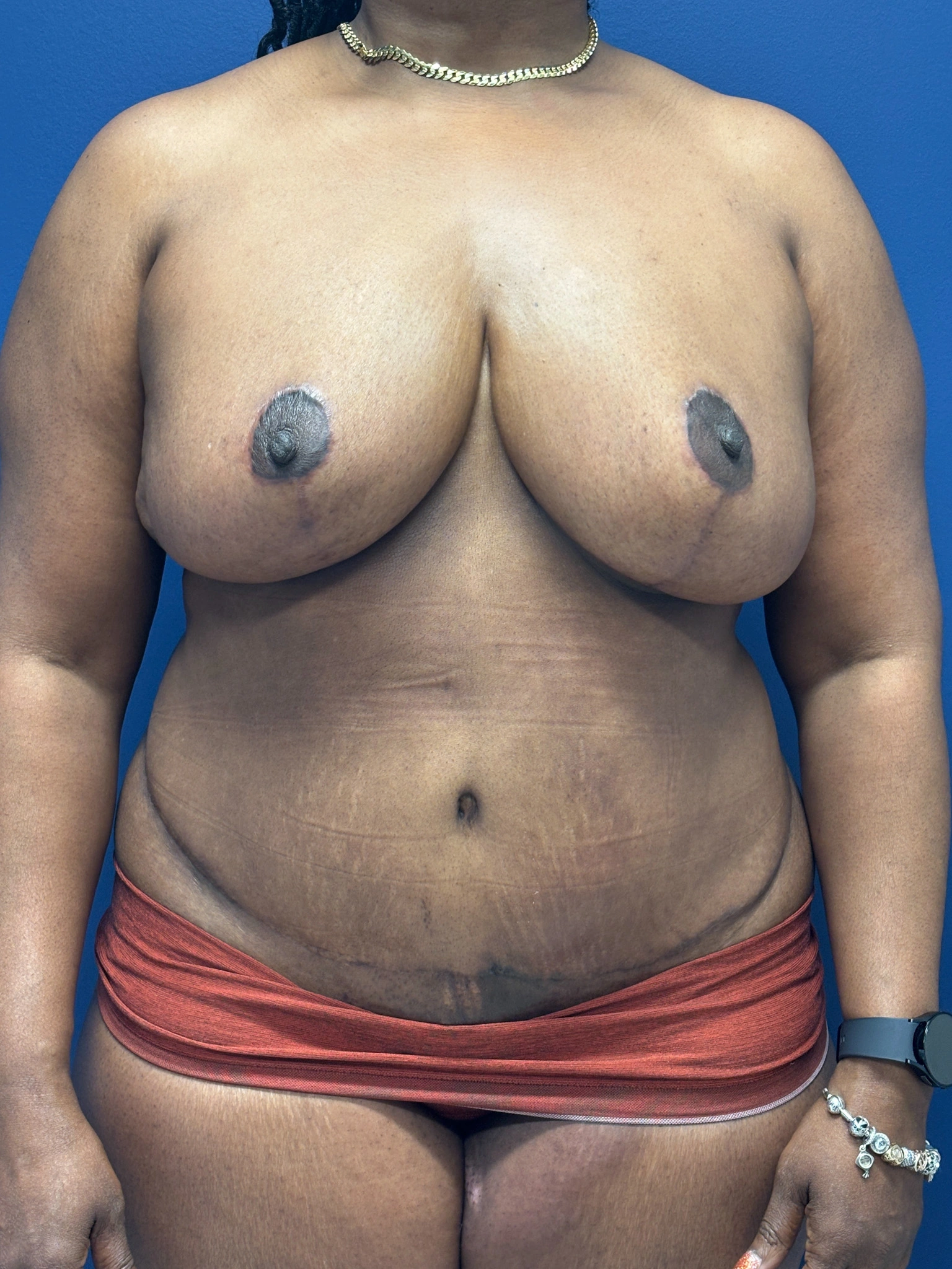 Abdominoplasty-Case--5907 | After Tummy Tuck 1