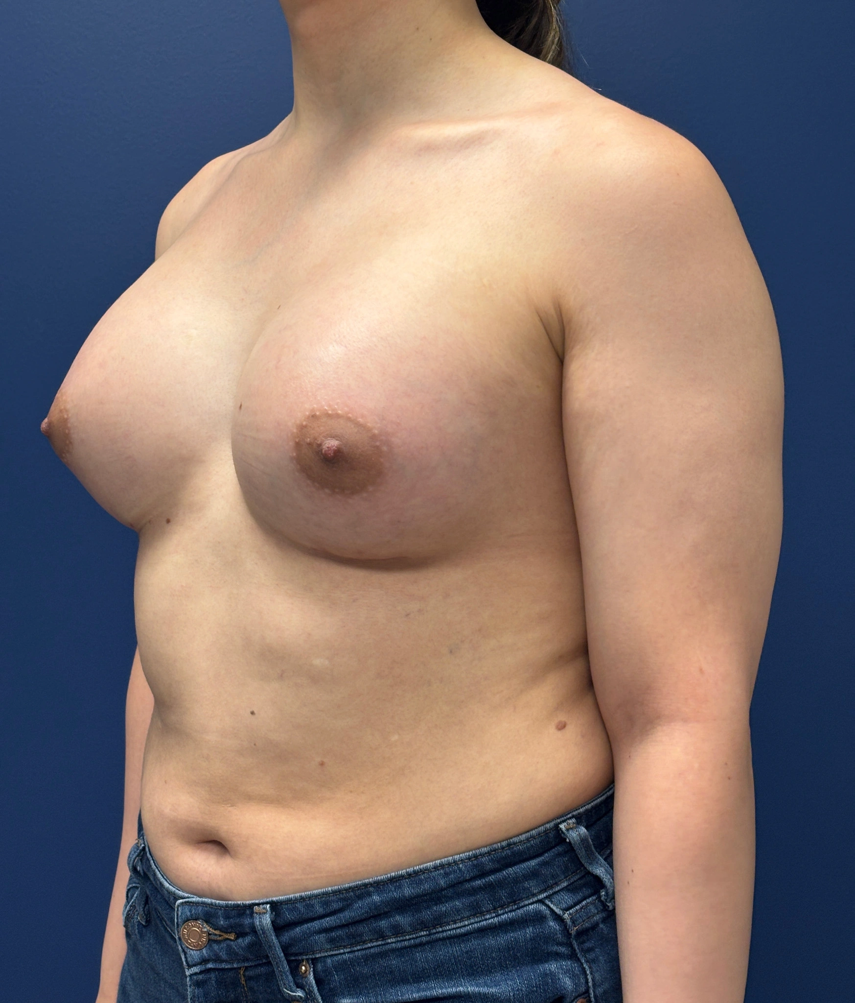 Breast-Augmentation-Case--2719 | After Breast Augmentation 4
