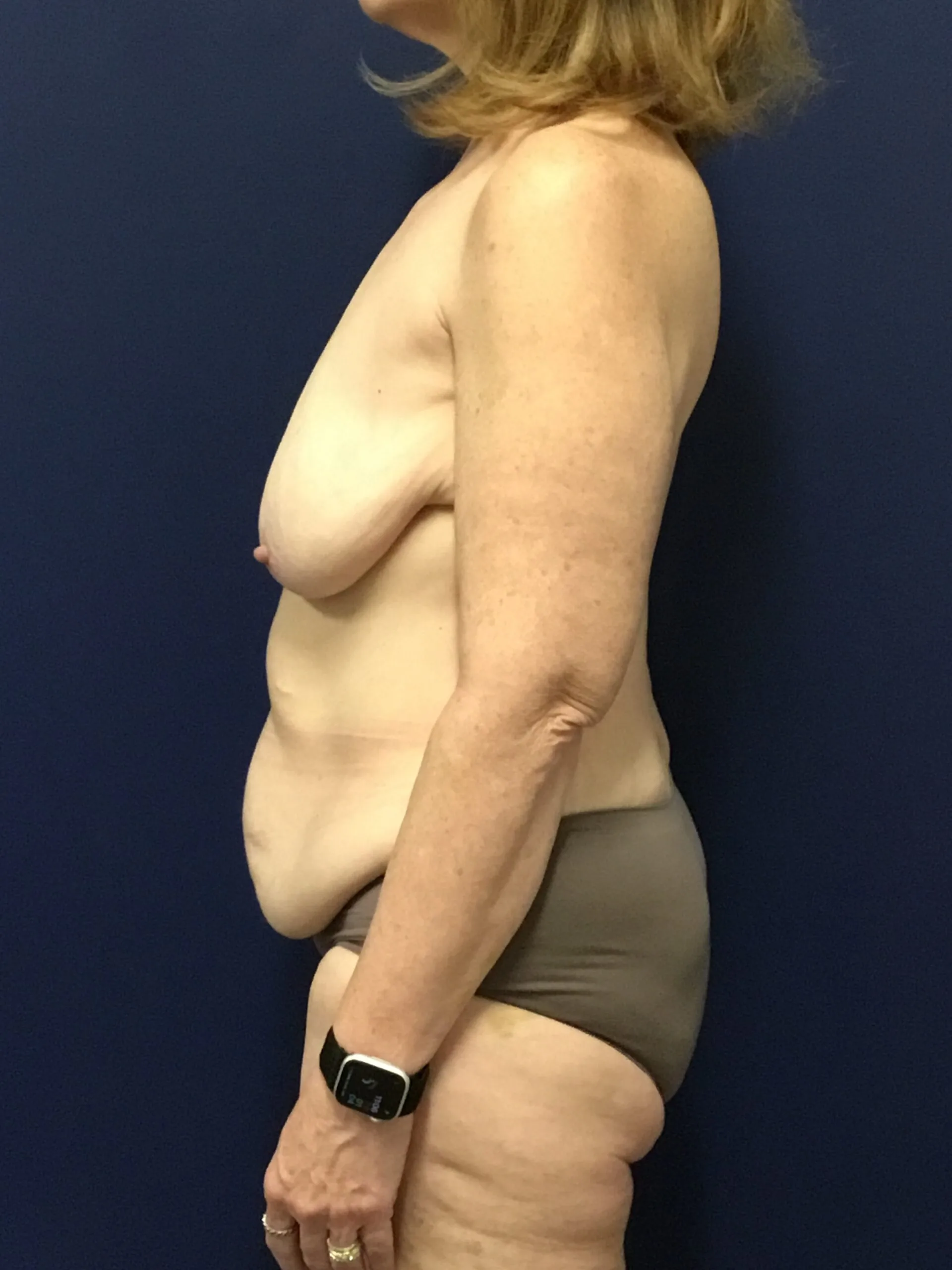 Abdominoplasty-Case--7412 | Before Tummy Tuck 3