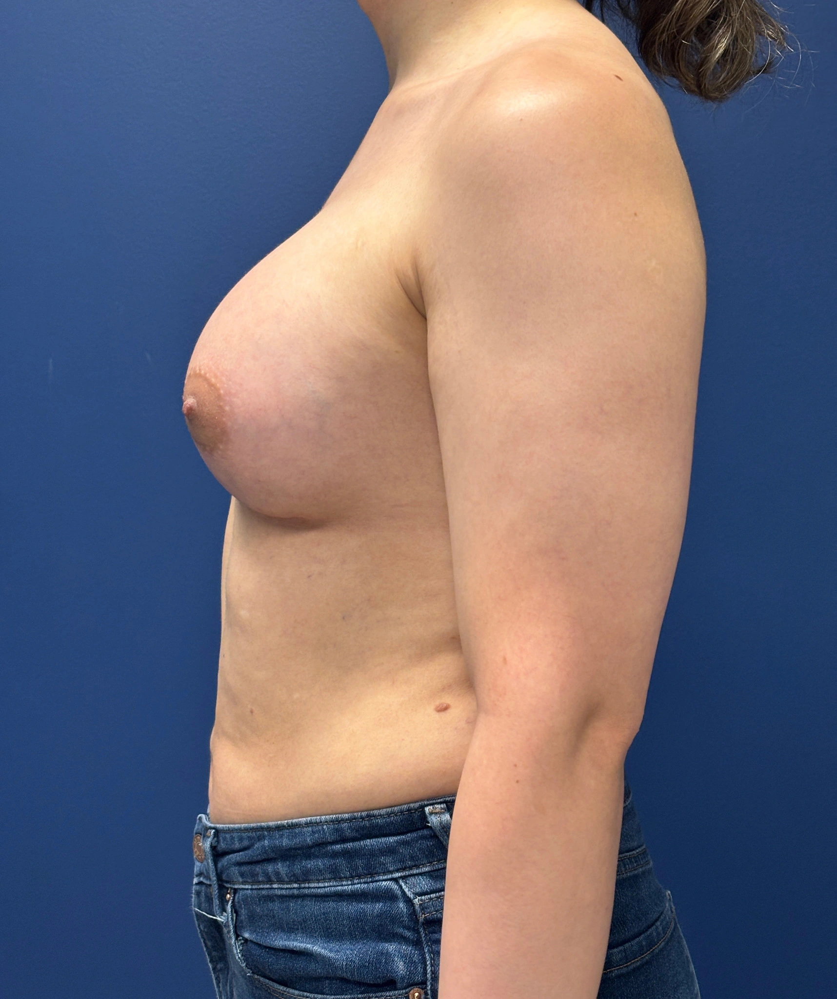 Breast-Augmentation-Case--2719 | After Breast Augmentation 2