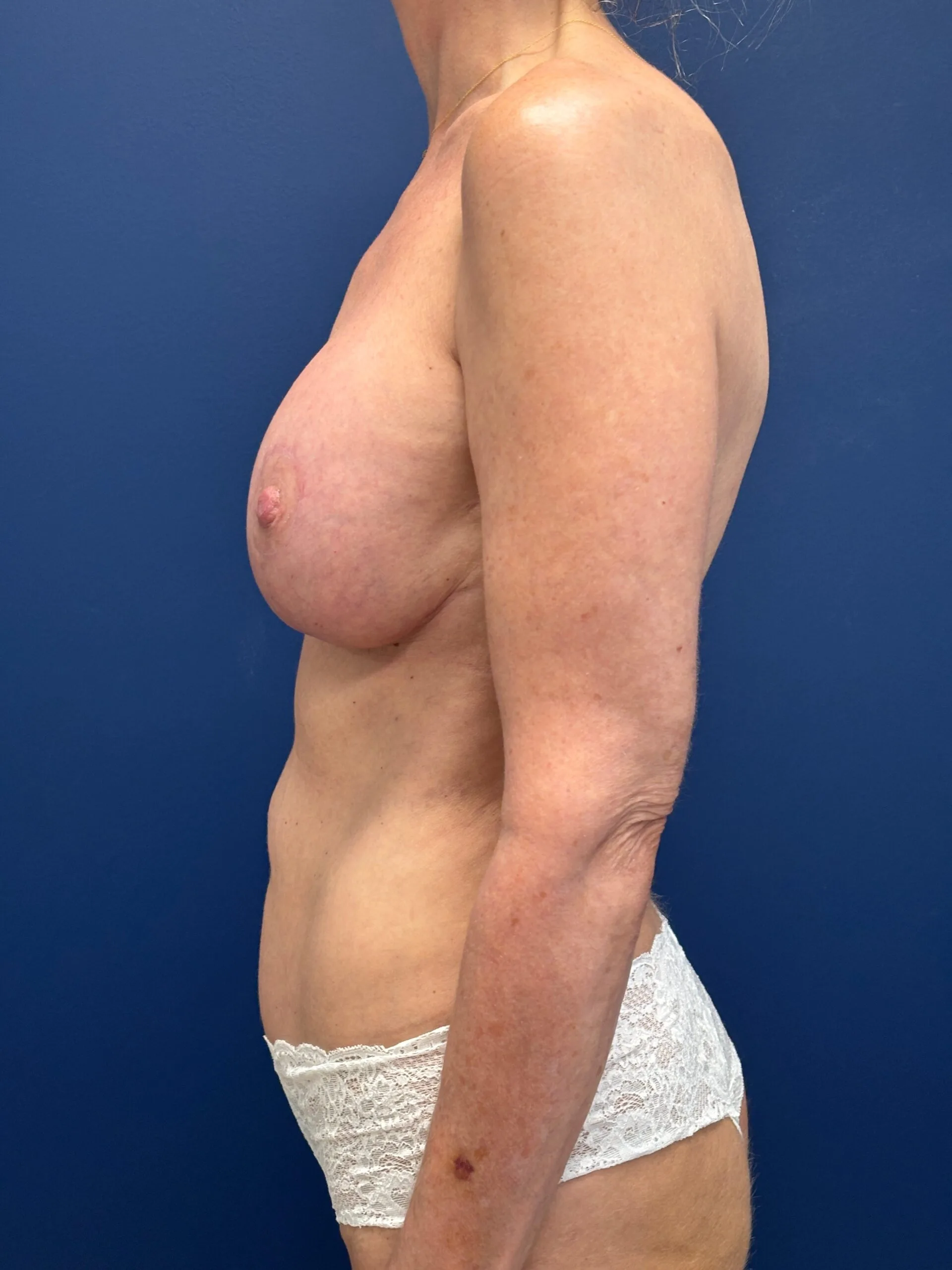 Augmentation-Mastopexy-Case--7491 | After Breast Augmentation With Lift 3
