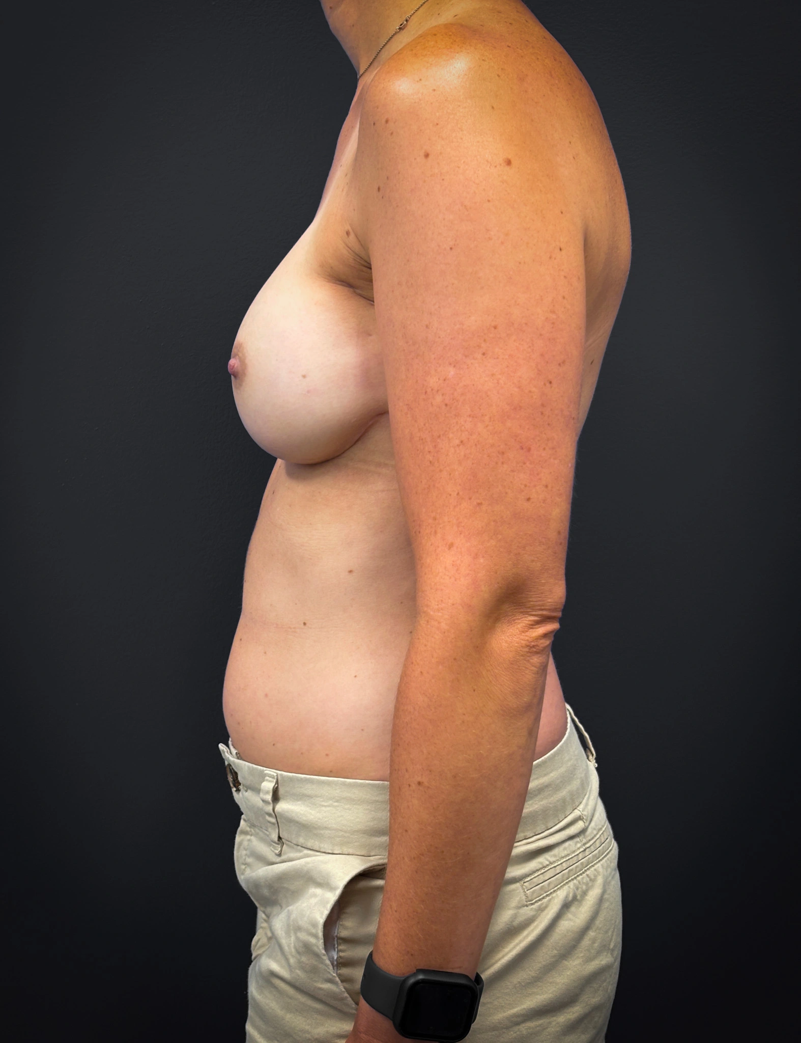 Bilateral-Mastectomy-Case--7380 | After Breast Augmentation With Lift 2