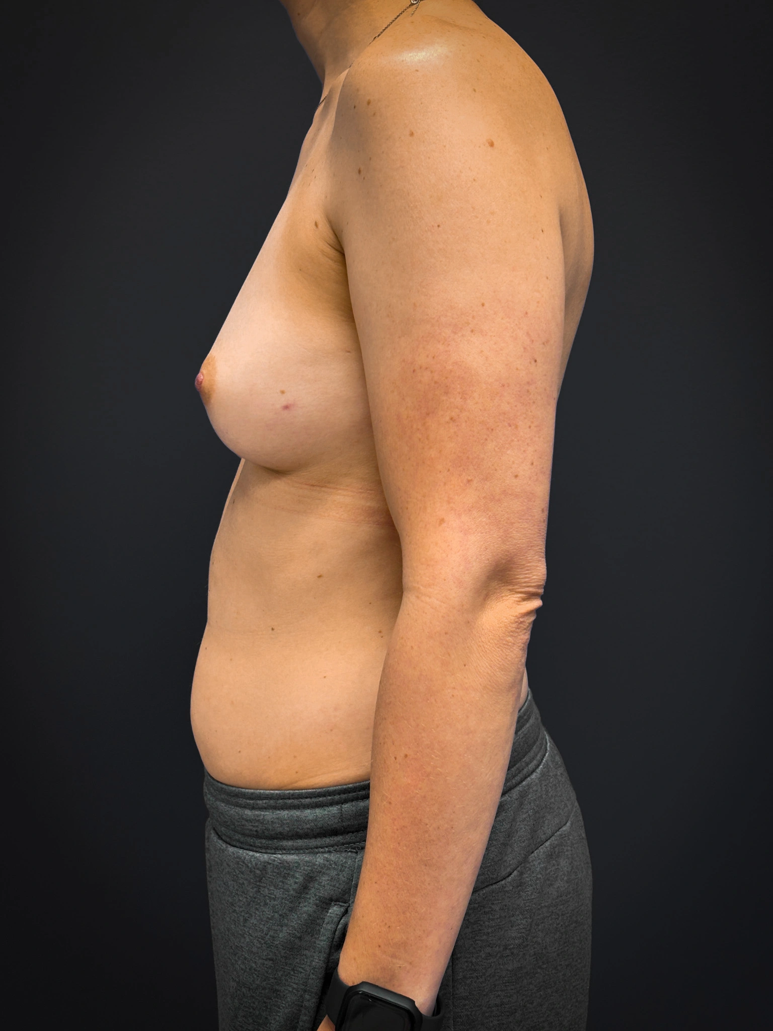 Bilateral-Mastectomy-Case--7380 | Before Breast Augmentation With Lift 2