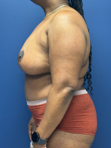 Abdominoplasty-Case--5907 | After Tummy Tuck 2