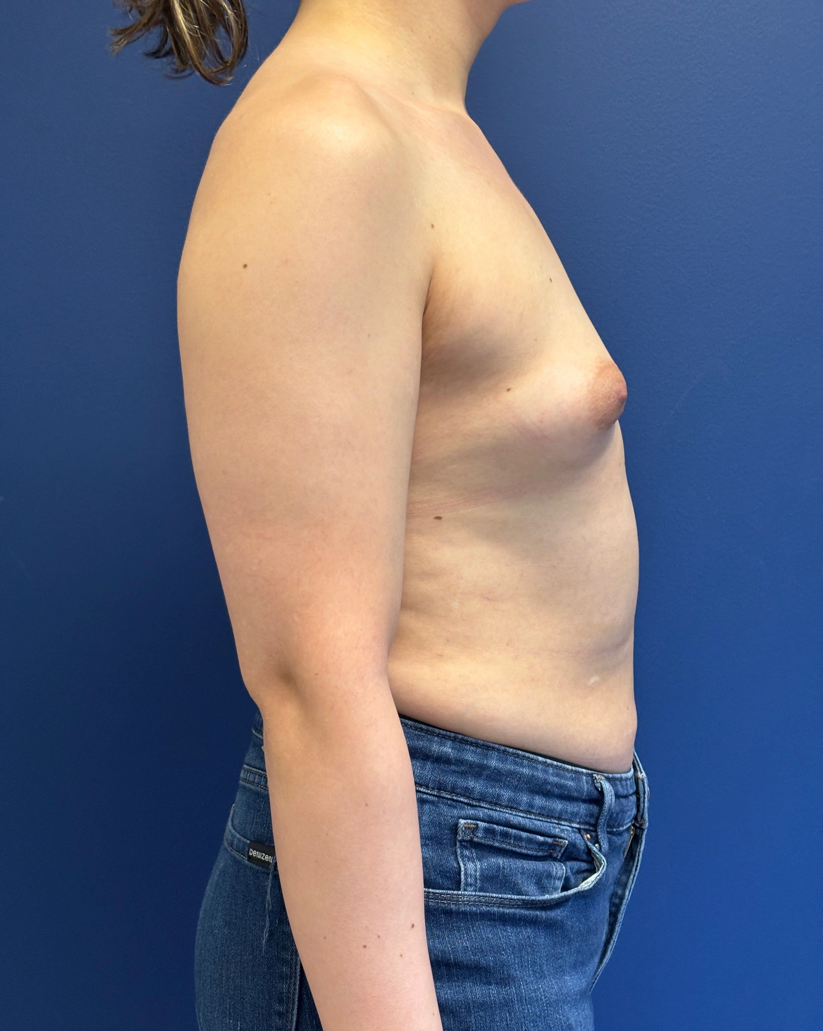 Breast-Augmentation-Case--2719 | Before Breast Augmentation 3