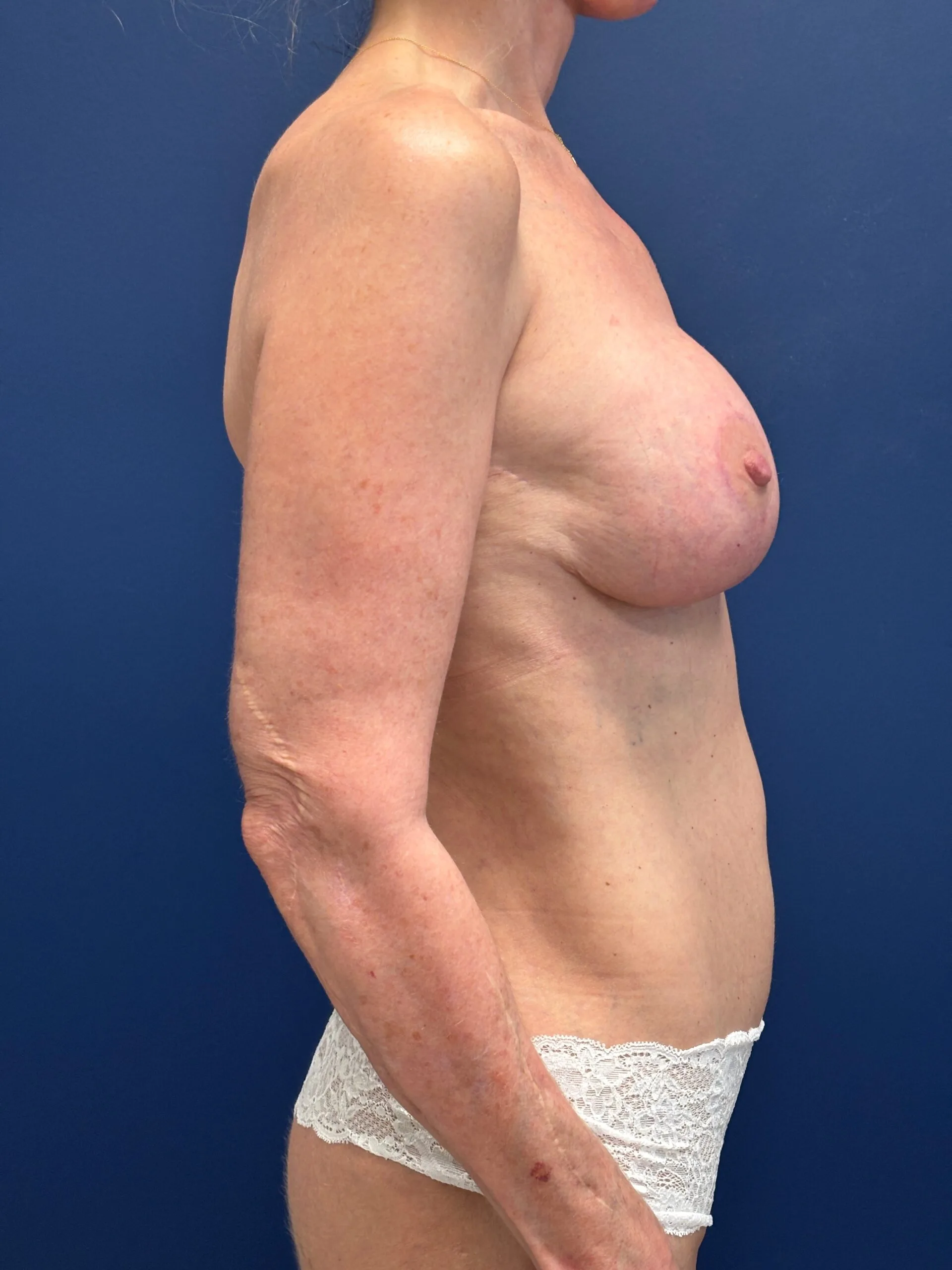 Augmentation-Mastopexy-Case--7491 | After Breast Augmentation With Lift 2
