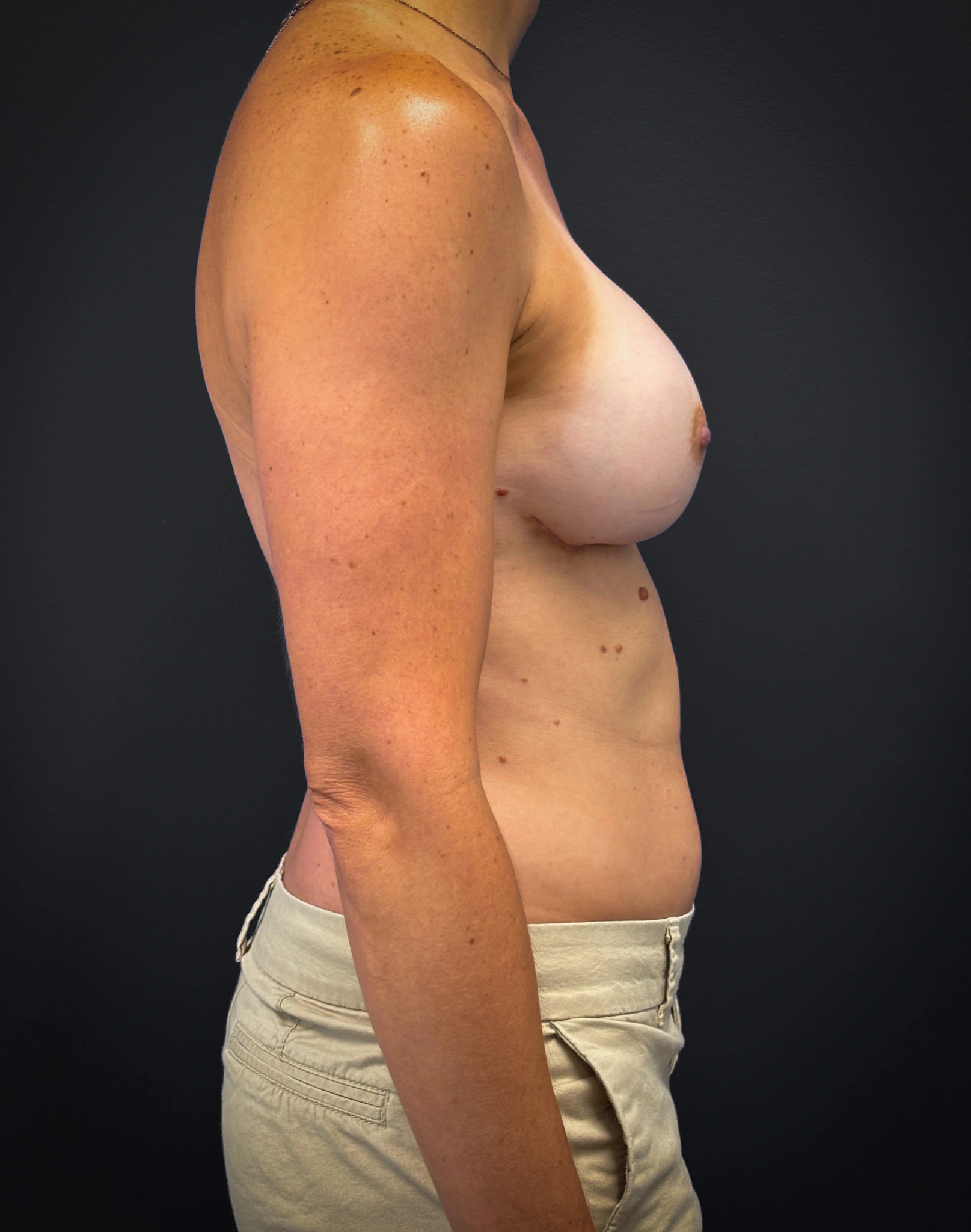 Bilateral-Mastectomy-Case--7380 | After Breast Augmentation With Lift 3