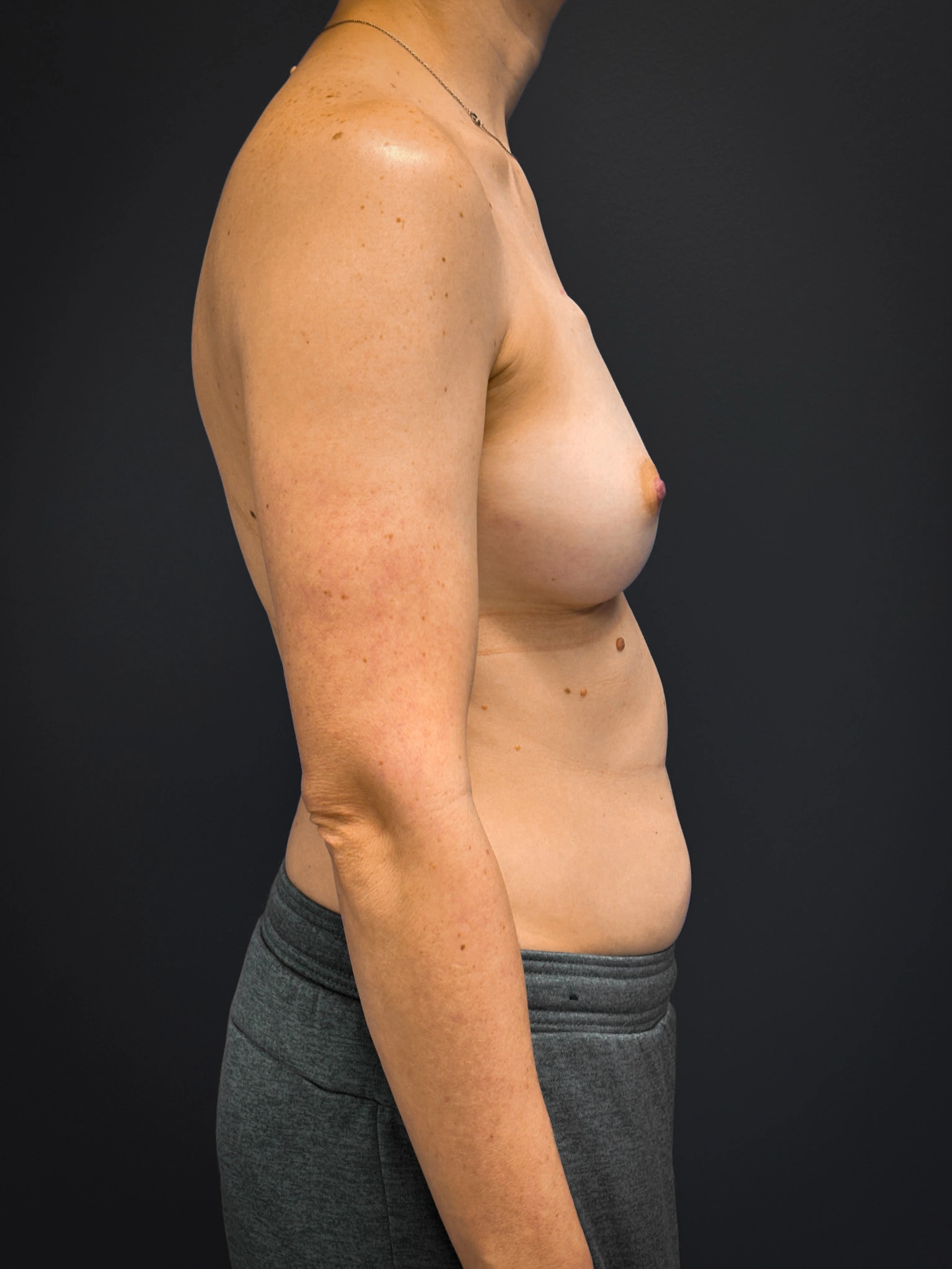 Bilateral-Mastectomy-Case--7380 | Before Breast Augmentation With Lift 3