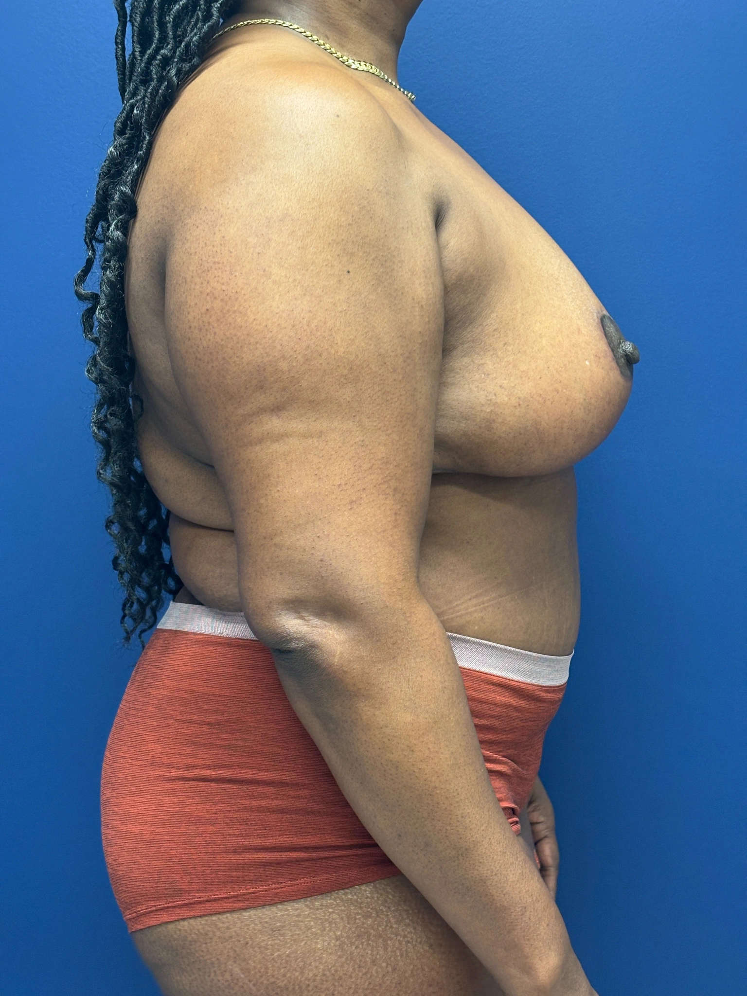 Abdominoplasty-Case--5907 | After Tummy Tuck 3