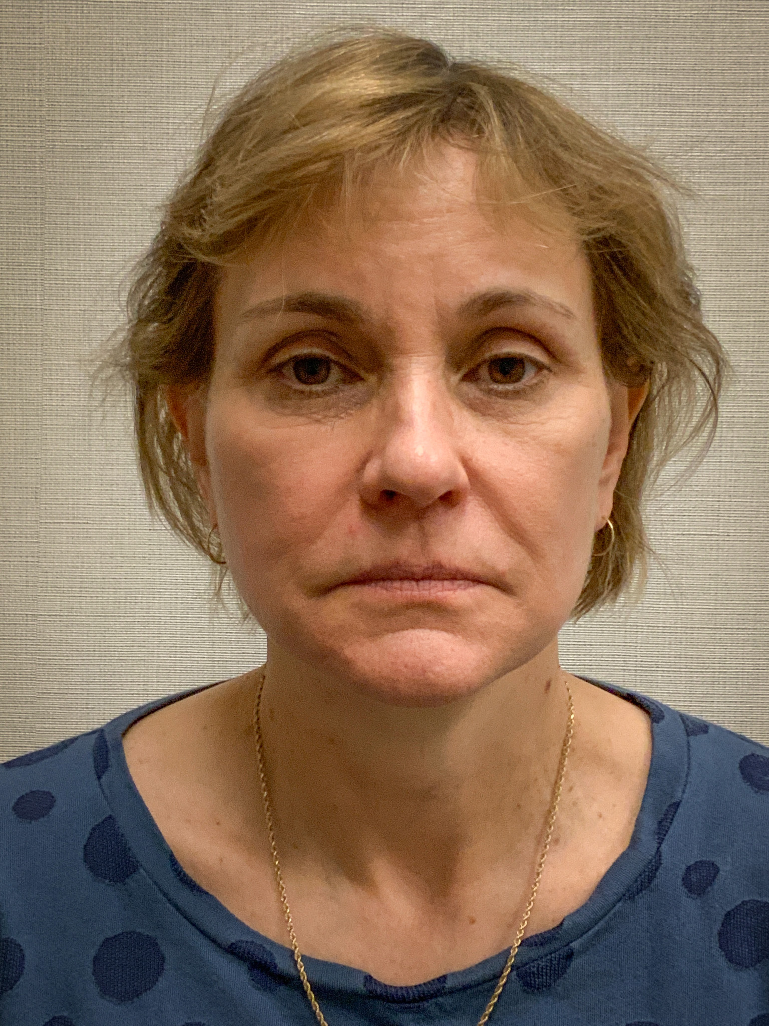 Facelift-Case--8739 | After Facelift 1