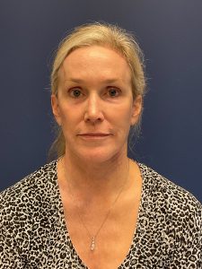 Facelift-Facial-Fat-Grafting-Brow-and-Neck-Lift-Case--9593 | After Facial Fat Grafting 1