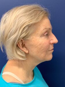 Facelift-Case--3746 | After Dr. Frank Albino 2