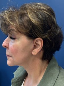 Facelift-Case--6613 | After Dr. Frank Albino 2