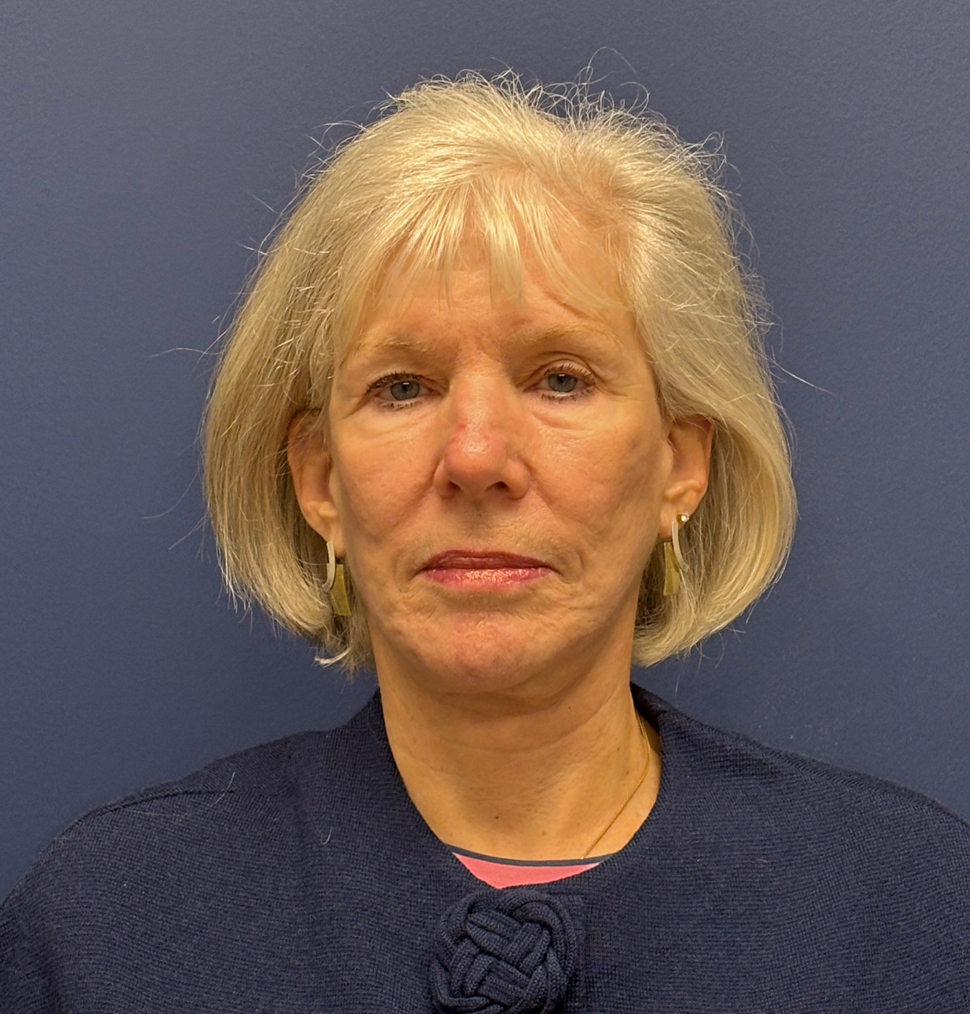 Facelift-Facial-Fat-Grafting-Neck-Lift-Case--1414 | After Face360 1