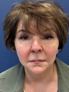 Facelift-Case--6613 | After Dr. Frank Albino 1