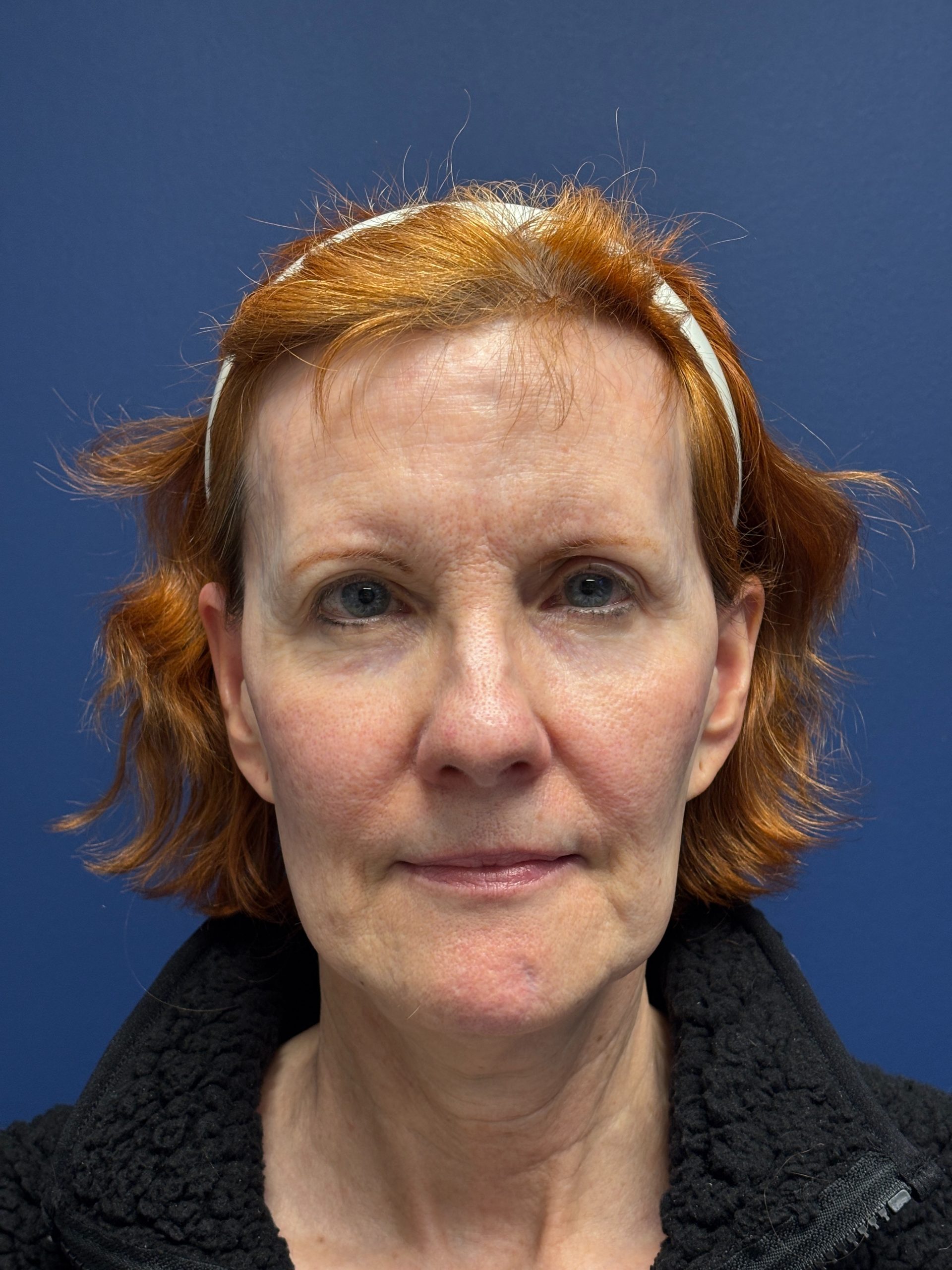 Facelift-Facial-Fat-Grafting-Neck-Lift-Case--6778 | Before Face360 1