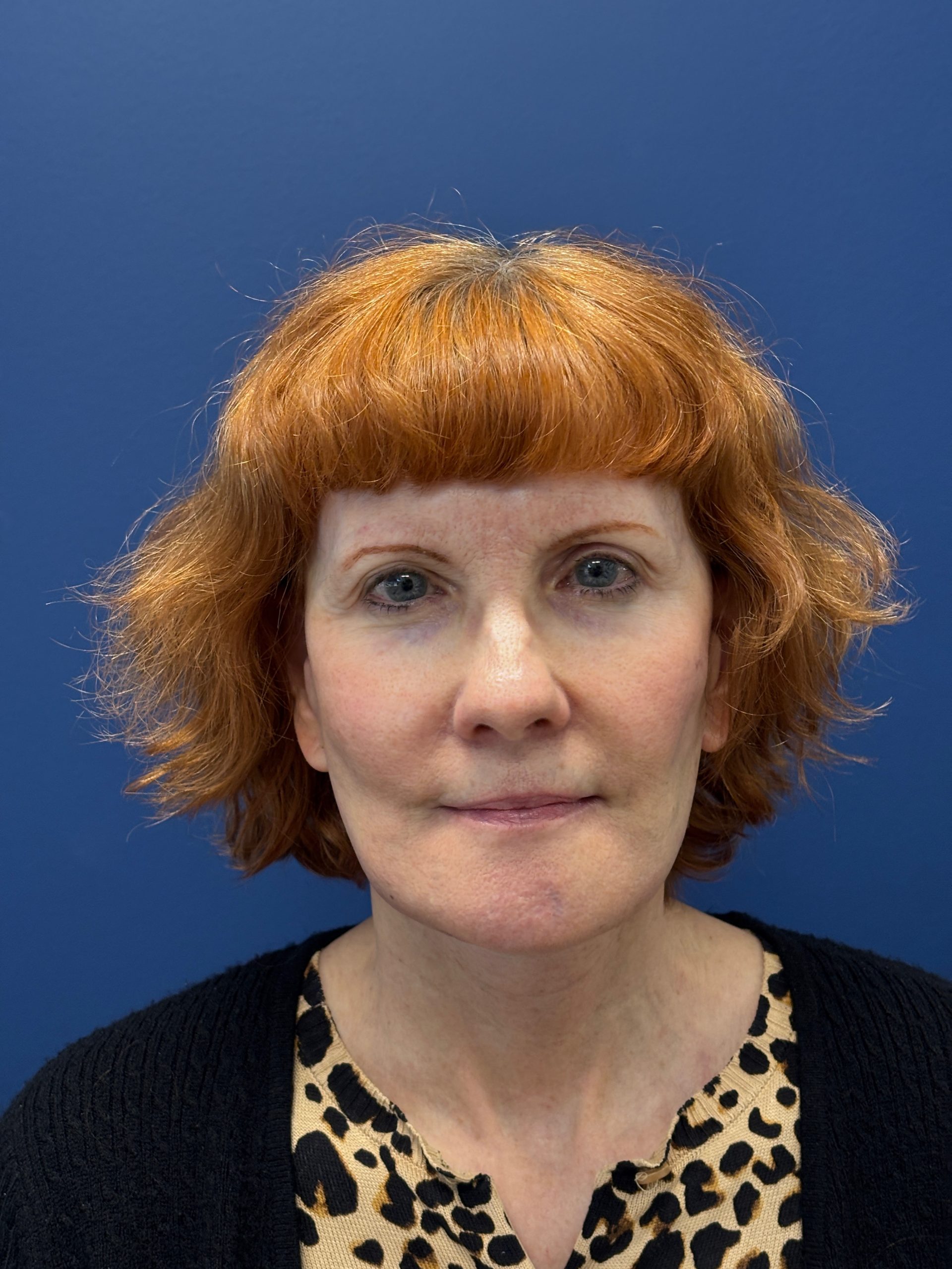 Facelift-Facial-Fat-Grafting-Neck-Lift-Case--6778 | After Face360 1