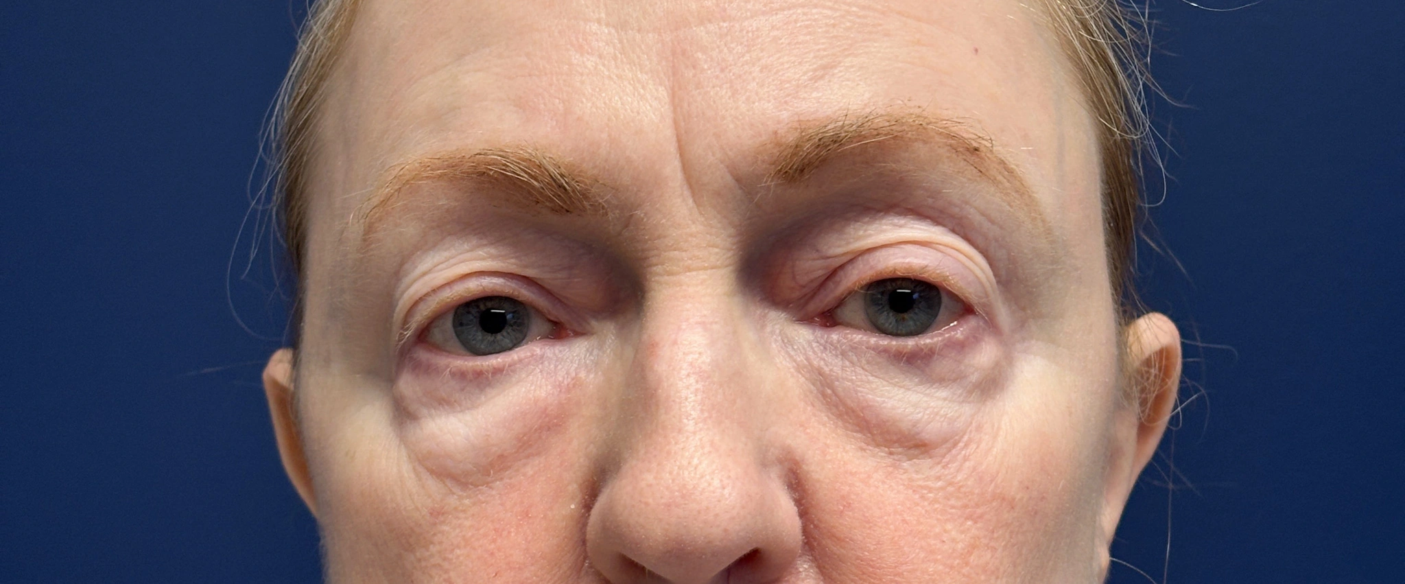 Blepharoplasty-Case--2019 | Before Eyelid Surgery 1