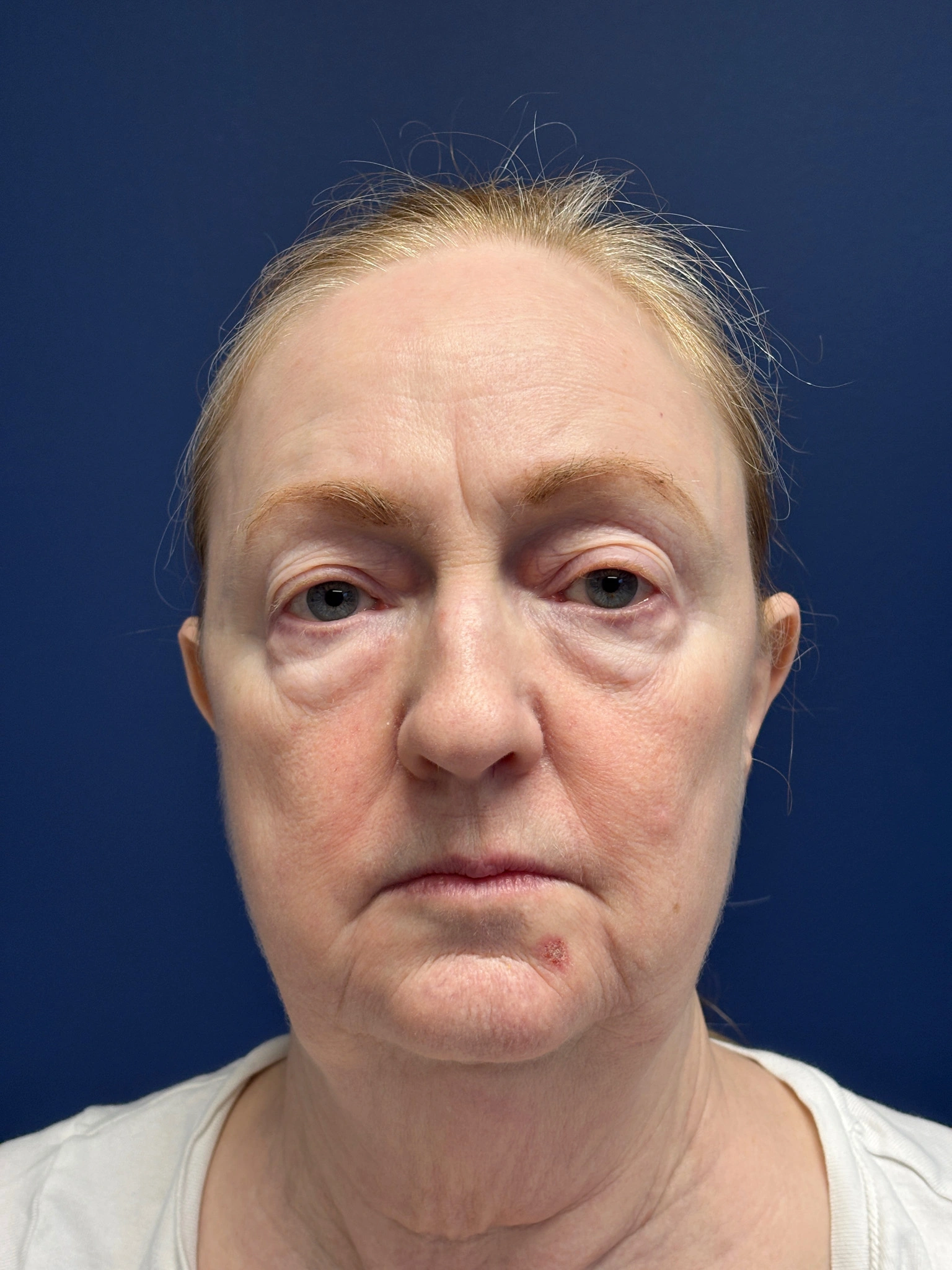 Facelift-and-Facial-Fat-Grafting-Case--3549 | Before Facelift 1
