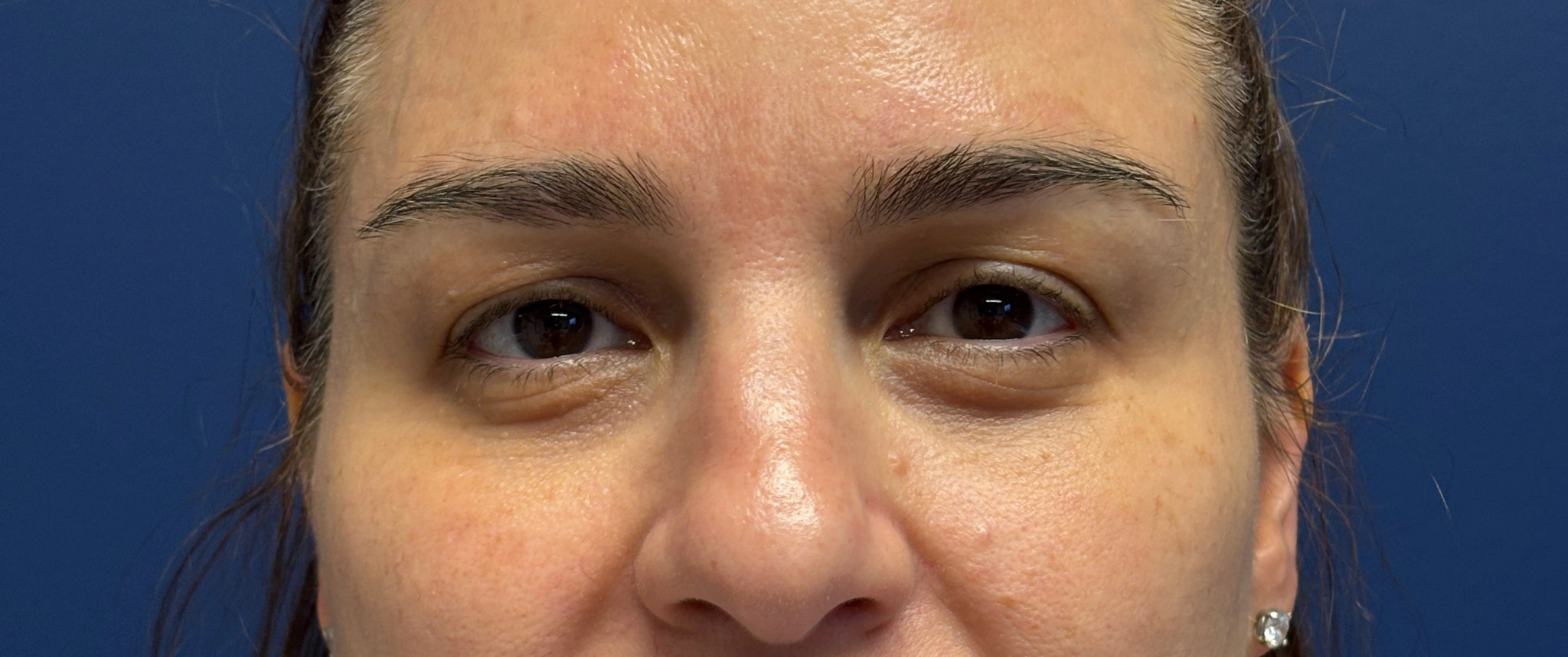 Blepharoplasty-Case--5118 | Before Eyelid Surgery 1