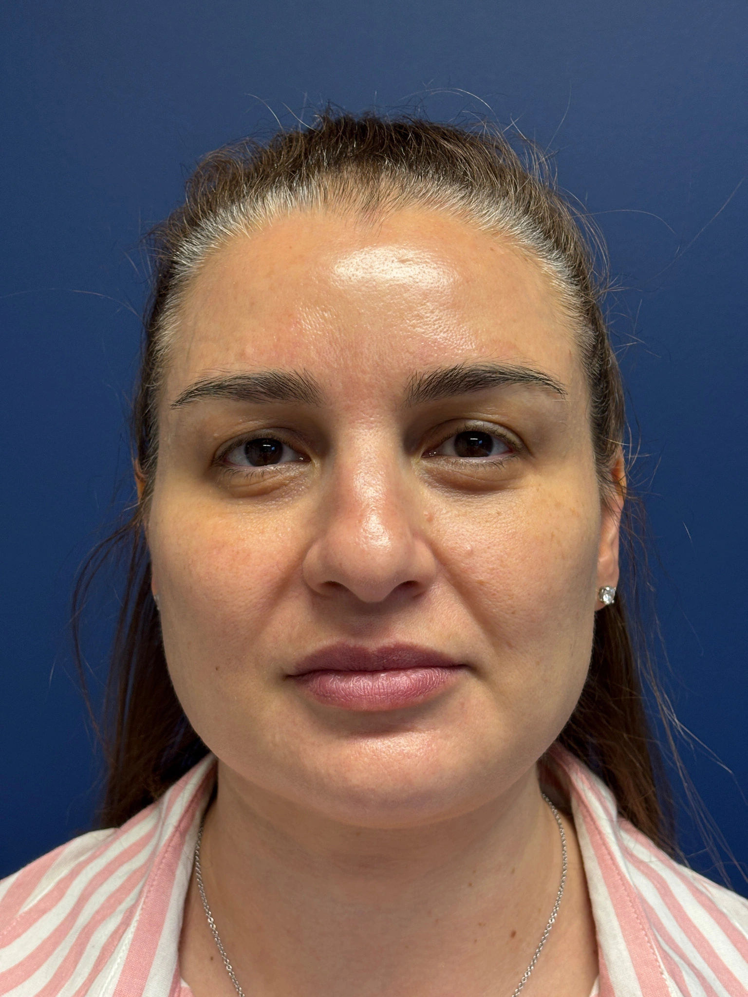 Facelift-and-Facial-Fat-Grafting-Case--7977 | Before Facelift 1