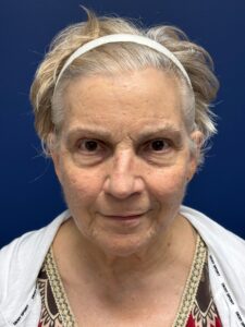 Facelift-Case--3746 | Before Dr. Frank Albino 1