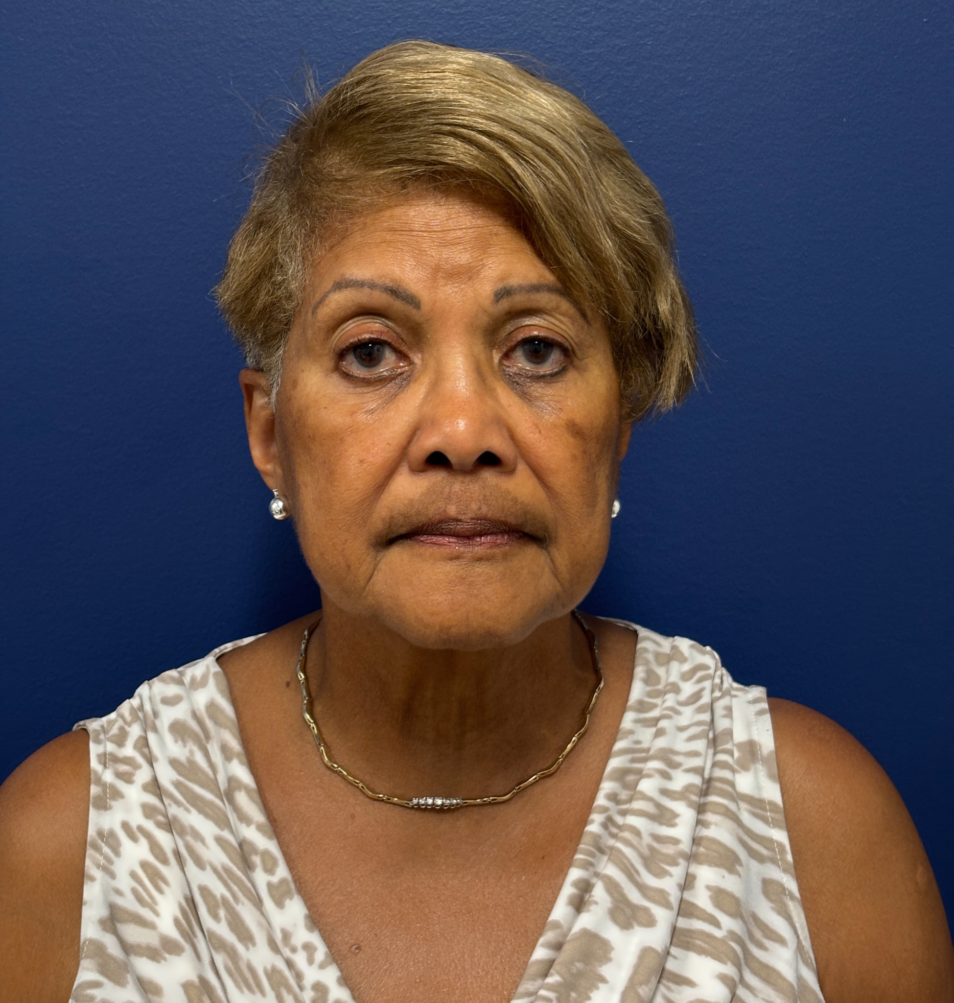 Facelift-Facial-Fat-Graft-Neck-Lift-Case--4262 | Before Face360 1